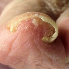 Wkręcające paznokcie - objawy, leczenie i profilaktyka