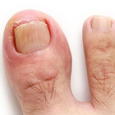 Sposoby na wrastające paznokcie czyli metody korekcji wrastających paznokci